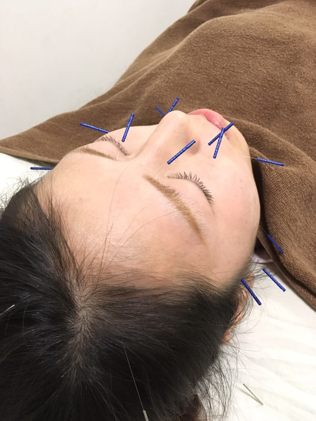目黒や恵比寿で大人気の美容針も口コミ多数いただいております。